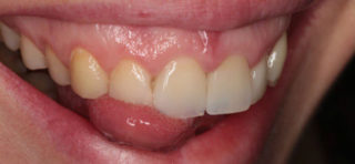 viniry na perednih zubah foto