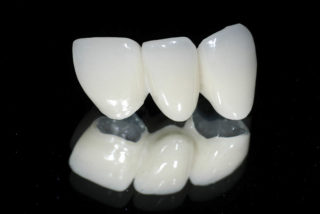 Виды зубных коронок: безметалловые коронки