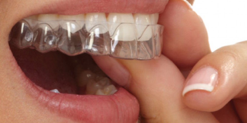 элайнеры-Стайл-С-стоматология