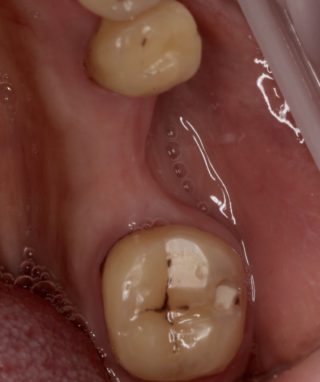 Primer protezirovaniya zubov most