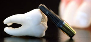 Dental'naya implantaciya zubov