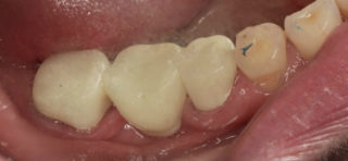Zubnoj most bystro stomatologiya
