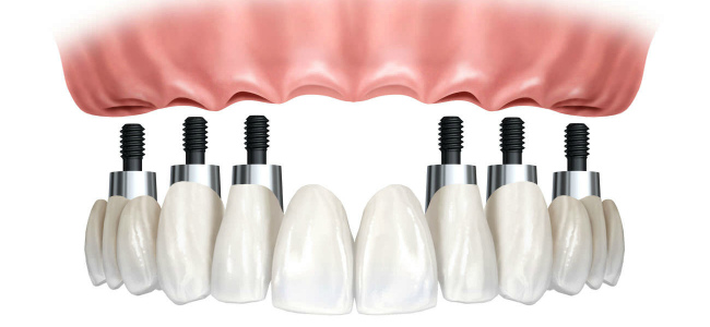 Polnaya implantaciya zubov