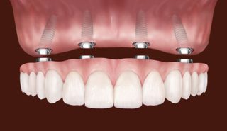 Protezirovanie zubov na implantah