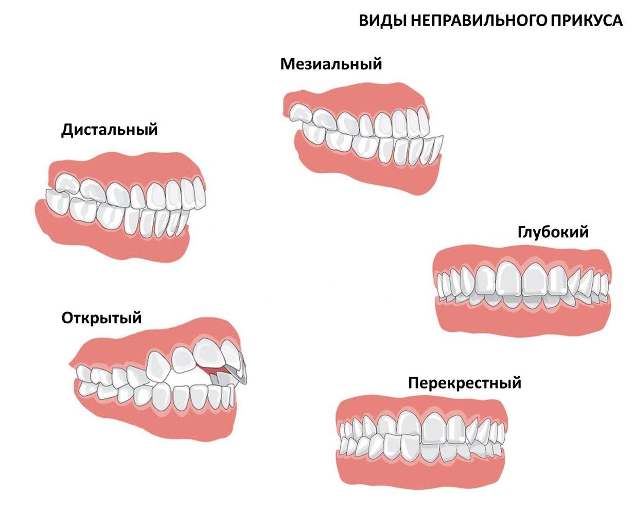 Виды прикуса схема