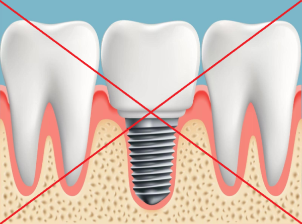 Что нельзя после имплантации. Рекомендации после имплан. Что нельзя делать перед имплантацией зубов. Имплантация зубов этапы установки и сроки.