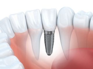 Имплантация зубов плюсы и минусы