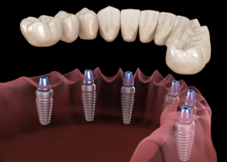 Имплантация зубов при отсутствии зубов