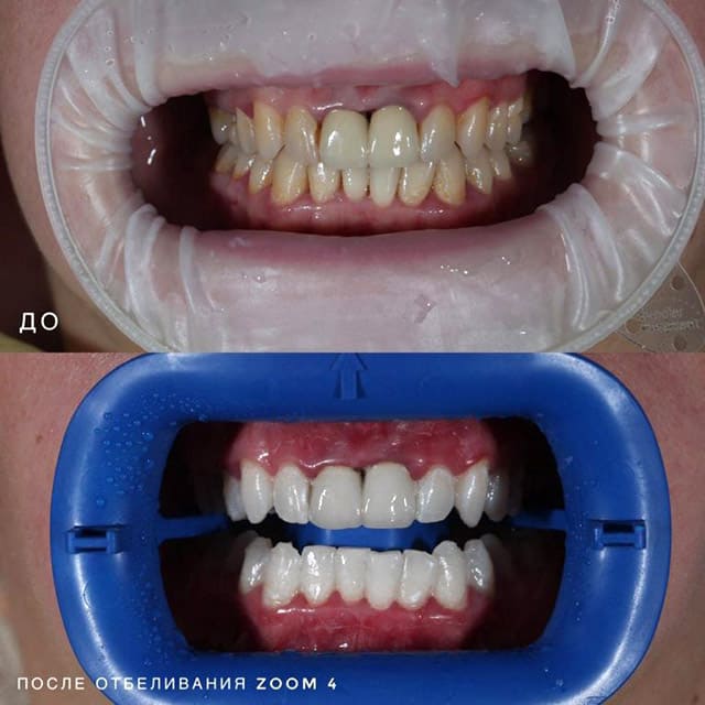 Отбеливание зубов Zoom