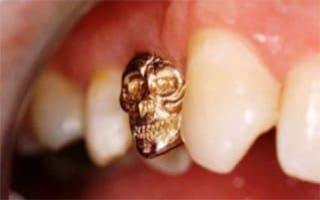 Металлические коронки на зубы