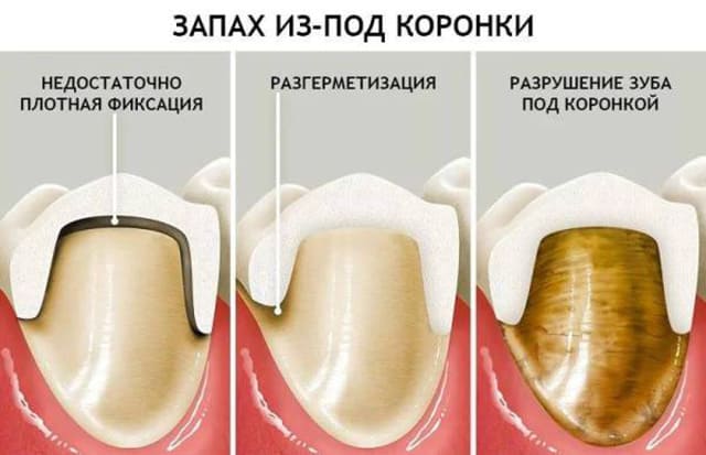 Неприятный запах из-под коронки