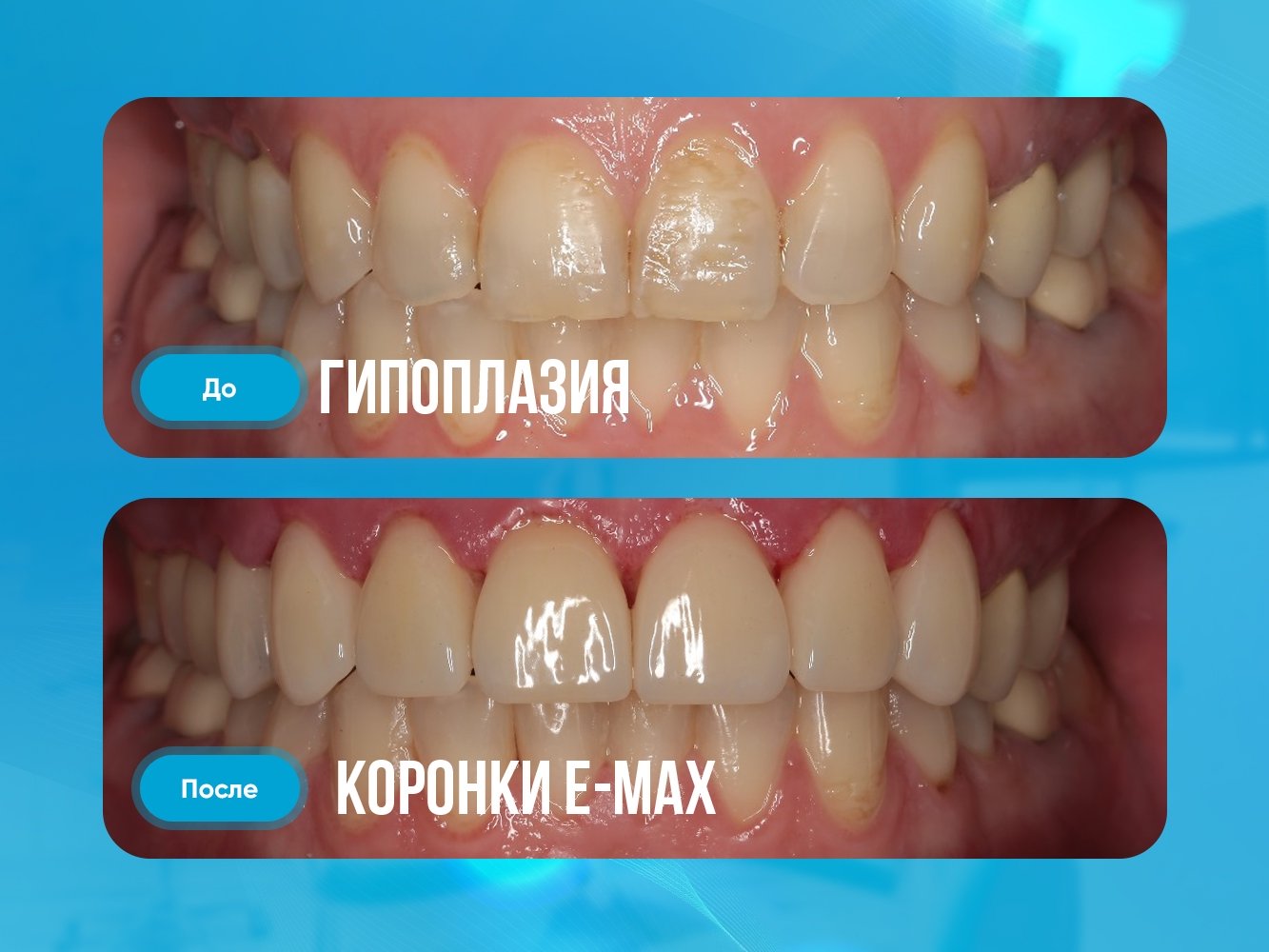 Гипоплазия и коронки E-max