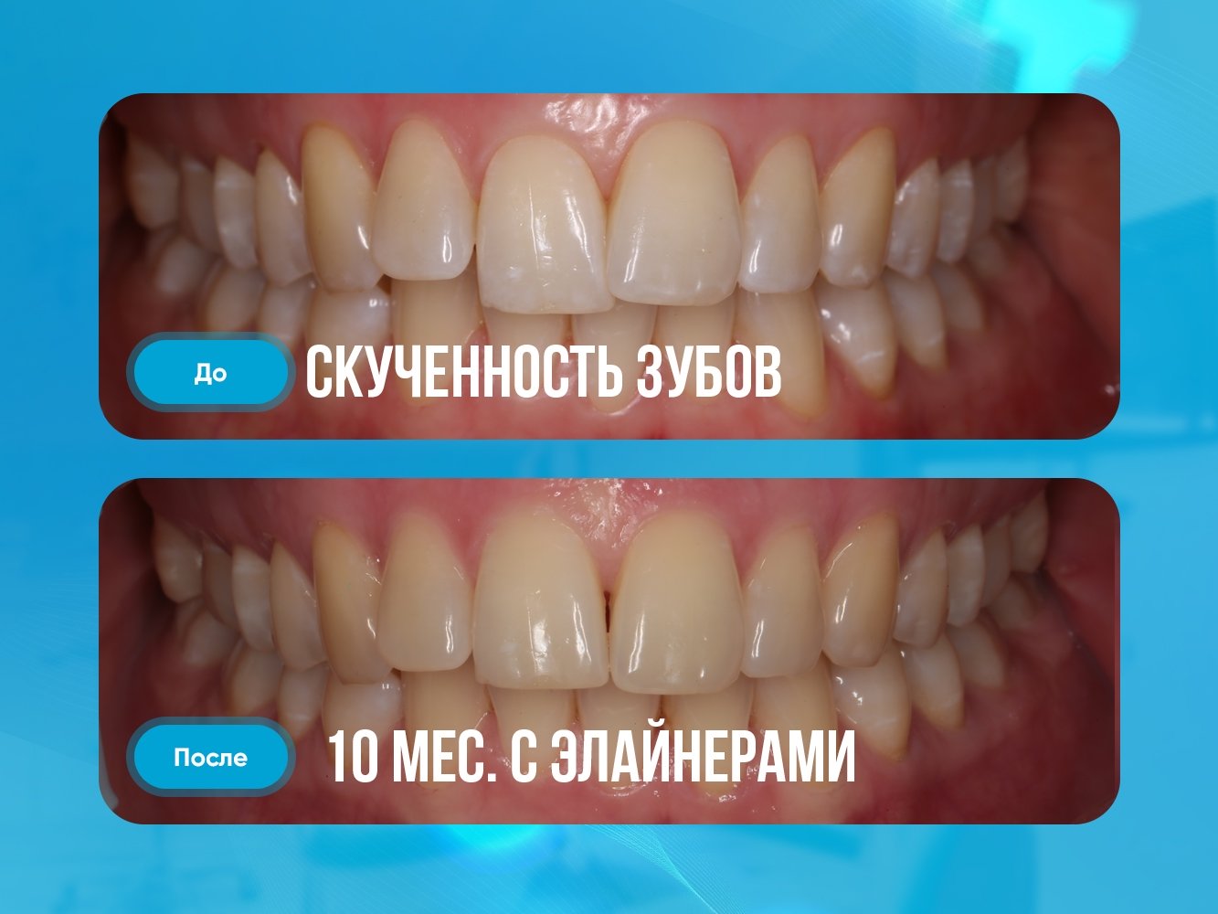 Лечение элайнерами за 10 месяцев