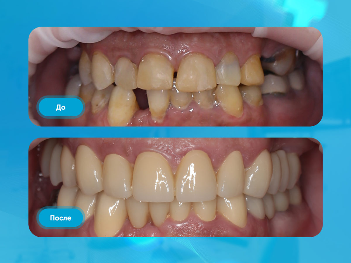 Имплантация зубов и коронки фото до после