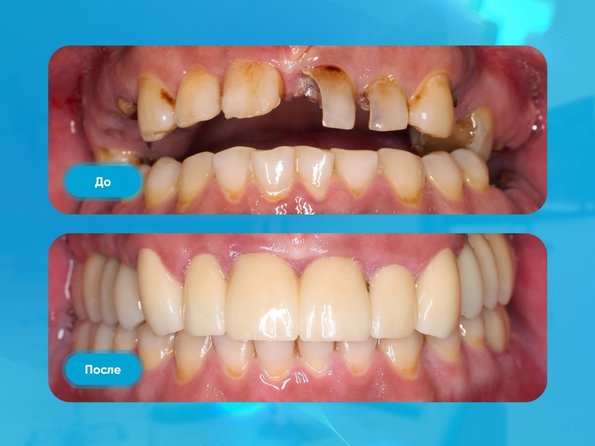 Тотальная реставрация зубов в Москве