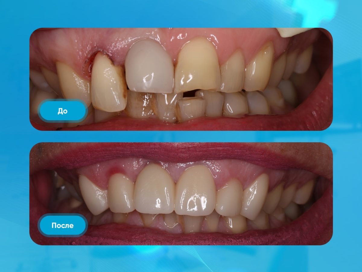 Тотальное восстановление зубов в Москве